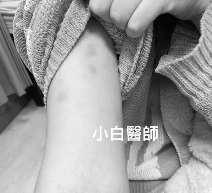 一名16歲少女手上出現小水泡,以為是「汗皰疹」或「蕁麻疹」,檢查才發現是 「二期梅毒」。(圖/翻攝自守護兒童急診的小白醫師 - Dr.王聖儒)