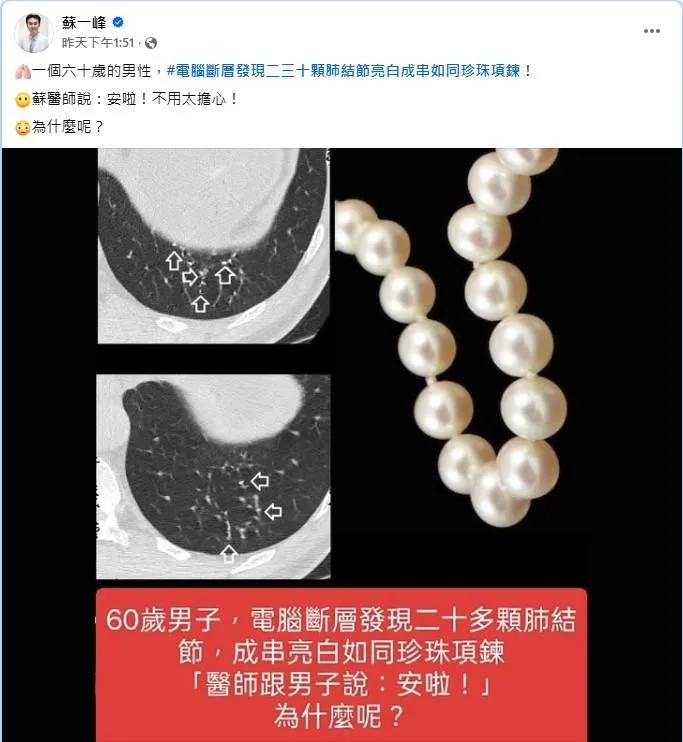 醫師在患者肺部發現20至30顆結節。（圖／翻攝臉書／蘇一峰）