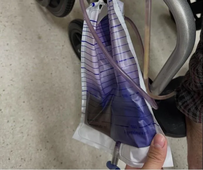紫尿袋症候群並非尿液本身變紫,也不是因為患者服用了特殊藥物或食物。(圖/曾浩翔臉書「泌尿科 曾浩翔醫師」)