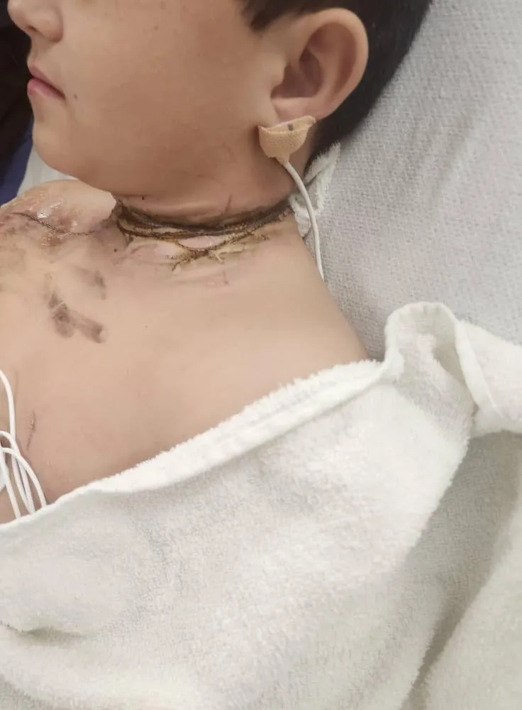 男童睡覺翻身項鏈卡充電器縫隙觸電燒傷。（圖／翻攝臉書「Kourtney Pendleton」）