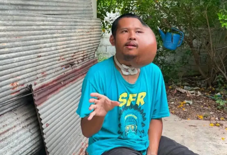 泰國31歲男子長期用牙籤剔蛀牙，致左臉發炎長出巨大腫瘤。（圖／翻攝自Facebook／Poramet Misomphop)
