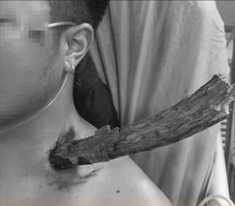 陝西男子樹下路過,天降「3公分粗」枯枝插頸穿胸。(圖/翻攝起點新聞)