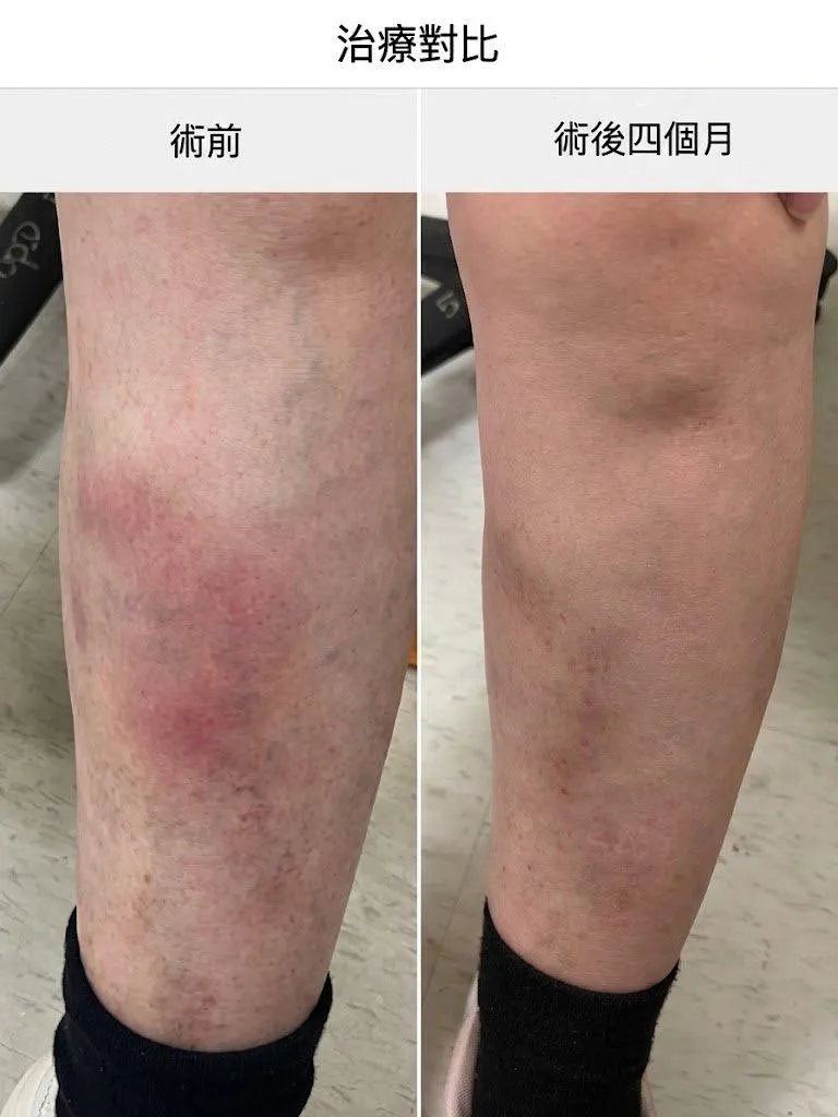 靜脈曲張合併急性血栓性靜脈炎,術前(左)、術後(右)比較。(圖/長庚醫院提供)