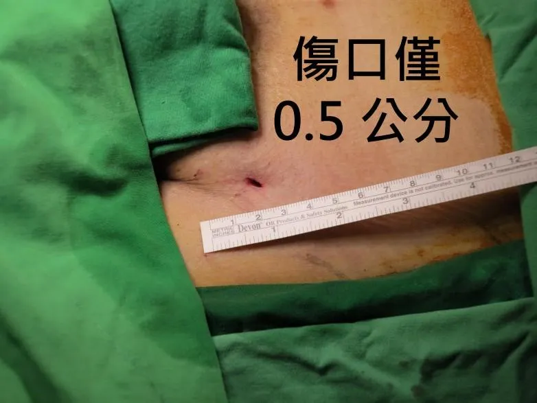 與傳統手術需20公分開胸傷口相比,客製化胸主動脈開窗支架手術僅需針孔小傷口。(圖/臺北榮民總醫院)