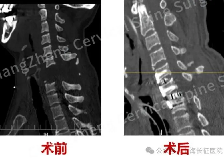 手術前患者頸椎完全斷裂,十分駭人。(圖/翻攝《網易》)