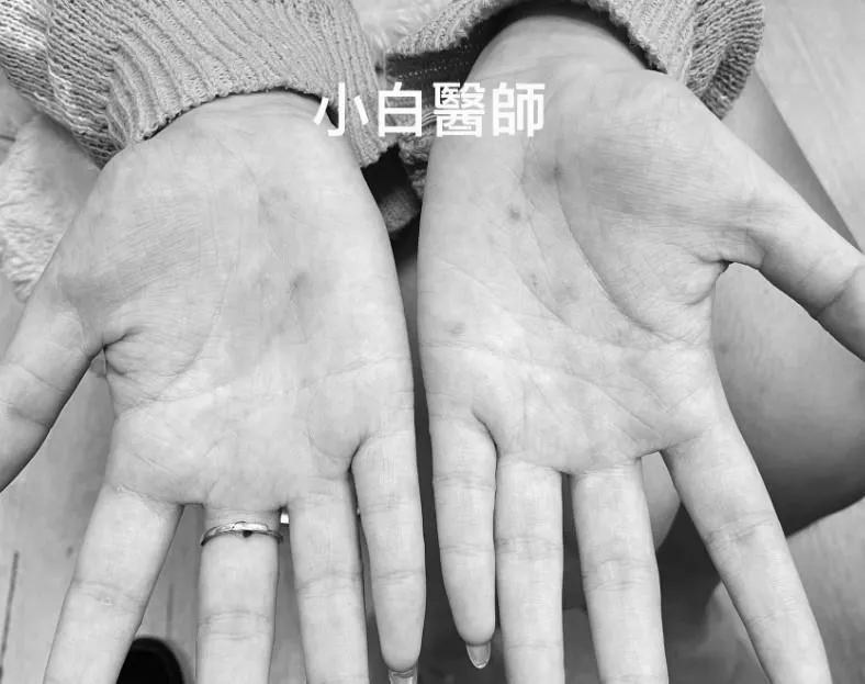 一名16歲少女手上出現小水泡,以為是「汗皰疹」或「蕁麻疹」,檢查才發現是 「二期梅毒」。(圖/翻攝自守護兒童急診的小白醫師 - Dr.王聖儒)