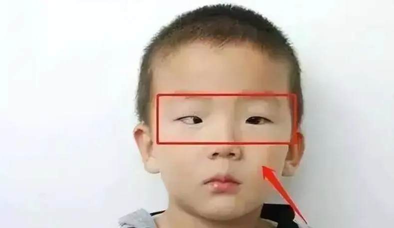 小明出現高度近視，甚至「黑眼珠正在消失」。（圖／翻攝搜狐網）