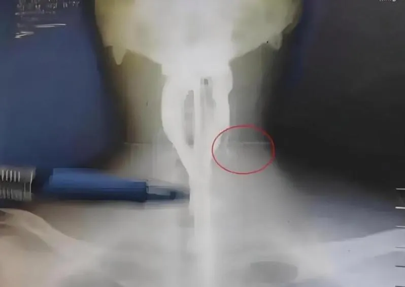 男子脖子腫痛 X光顯示內有異物。（圖／翻攝環球網）