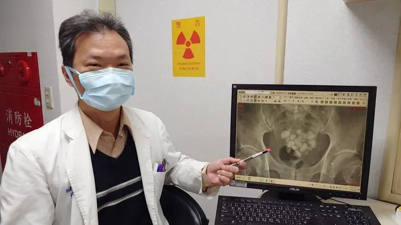 一名老翁因排尿困難就醫,醫師黃才倍安排照X光,於老翁膀胱發現20幾顆大小結石。(圖/中央社)