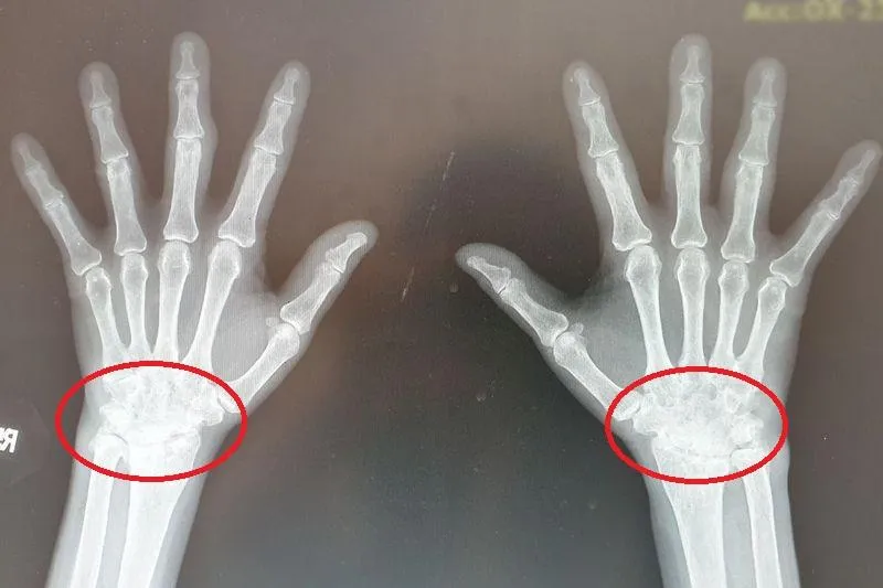 類風濕性關節炎不可逆，置之不理恐造成關節損壞。（示意圖／資料照）