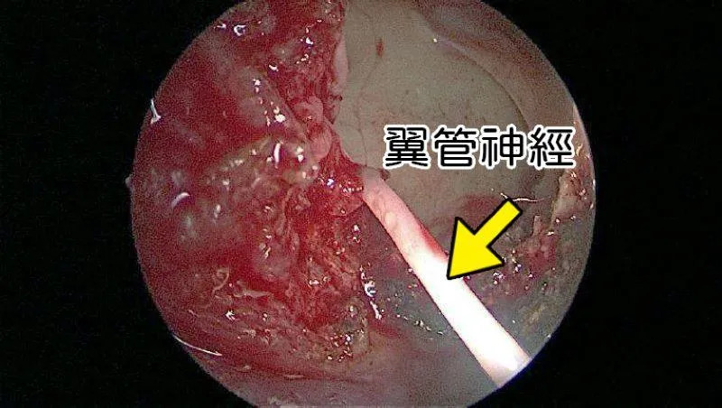 內視鏡經蝶竇找到翼管神經，將之截斷2-3公分，使過敏性鼻炎不容易復發。（圖／台北慈濟醫院）