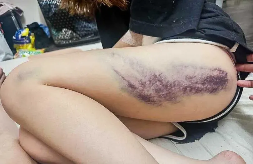 受害女子遭球棒暴打，手、腳有大片瘀青，頭部也被打到流血，傷勢怵目驚心。（圖／翻攝自Threads）