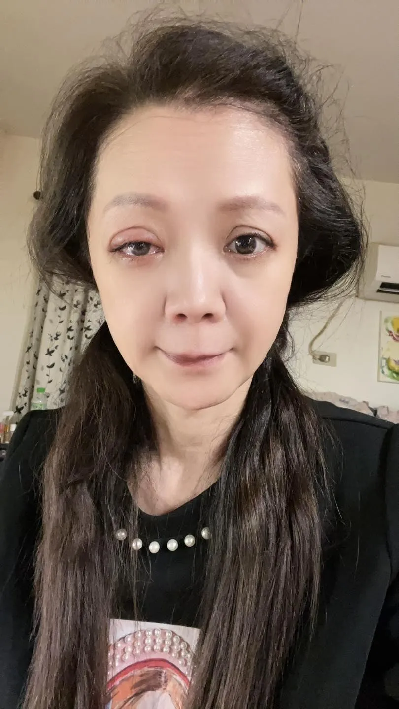 高欣欣眼瞼受傷破皮嚴重。（圖／翻攝高欣欣 欣想事成俱樂部）