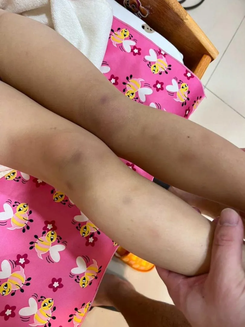 受害家長在今年2月孩童下課後，發現孩子腳上遍布點狀瘀青。（圖／受害家長提供）