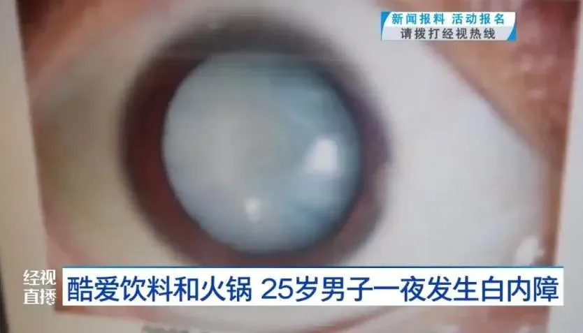 25歲男子患「代謝型白內障」瞳孔中全變白。（圖／翻攝紅星新聞）