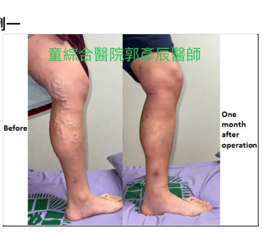 男子因為長時間久站，左腿第二期靜脈曲張，腿部血管外觀看起來像是「爬滿了蚯蚓」。（圖／翻攝自童綜合醫院美容中心臉書粉專）