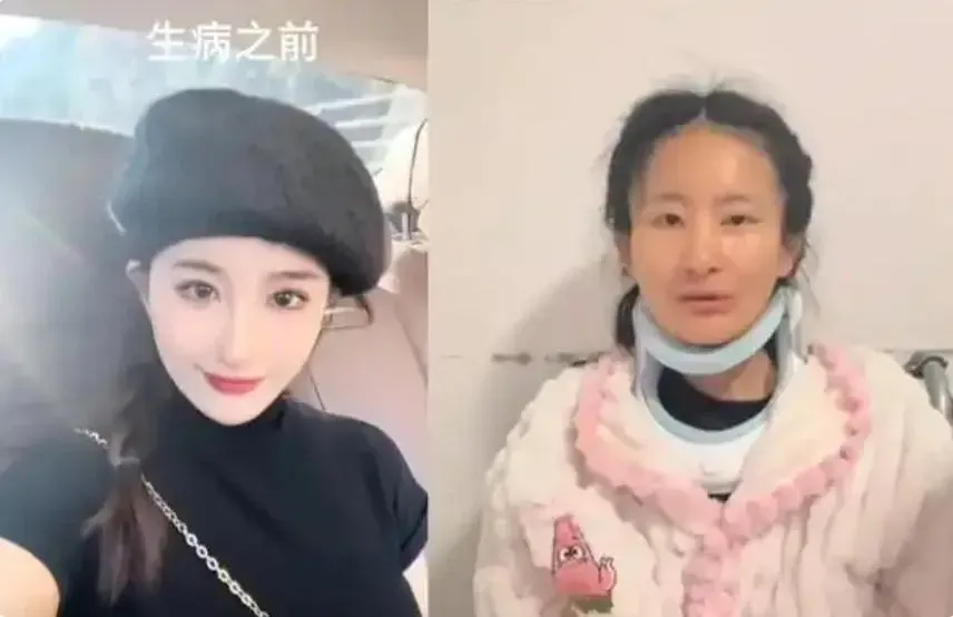 小陳確診漸凍症短短一年容貌巨變。（圖／翻攝極目新聞）