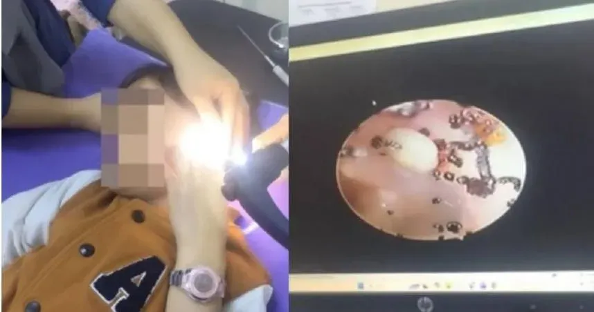 馬來西亞一名女童和父母說自己耳朵痛,就醫檢查發現她的耳蝸有大量跳蚤活動。(圖/翻攝自臉書/Aqila Nasir)
