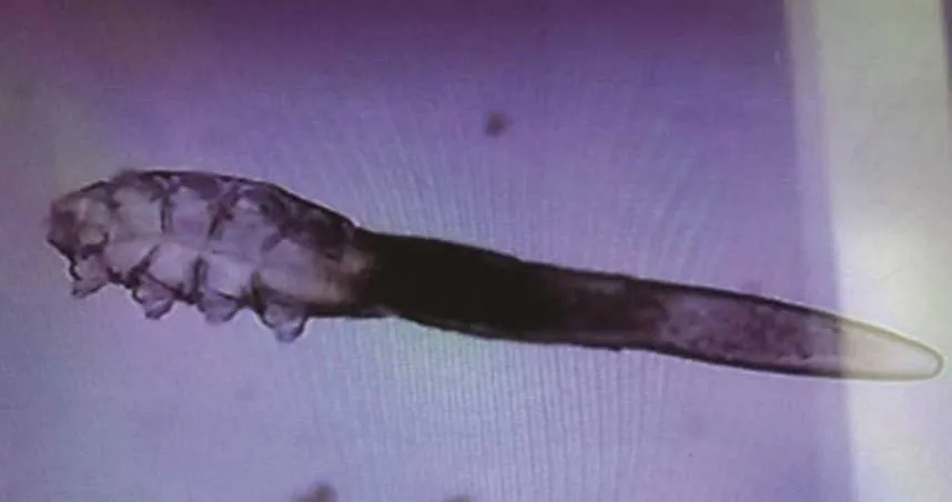 醫生初步判斷,張女患上了丘疹性蕁麻疹,而罪魁禍首很可能是涼蓆上滋生的蟎蟲。(示意圖/翻攝自溫州新聞網)