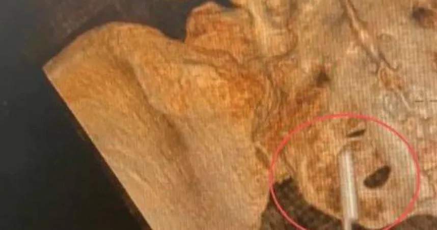 大陸湖北省武漢市一名胡姓女子近日在體檢時意外發現，體內有一段約2公分的異物。（圖／翻攝自紅星新聞)