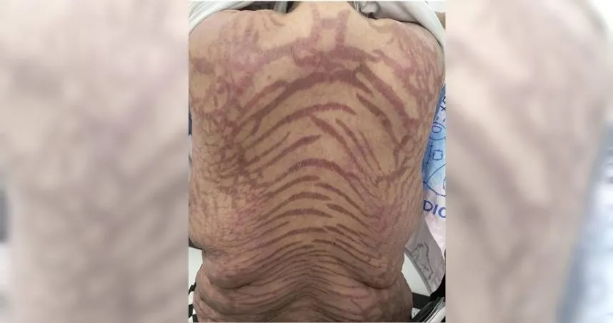 40歲女子美美（化名）長年塗抹網購藥物，醫師指出藥膏成分是強效激素，對身體有害。（圖／翻攝自微博／揚子晚報）