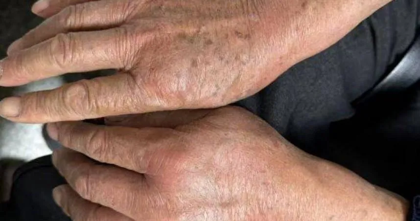 68歲的羅大伯（化名）在翻動院子角落堆放的乾草堆時，被突然竄出的螞蟻群咬傷。（圖／翻攝自羊城晚報）