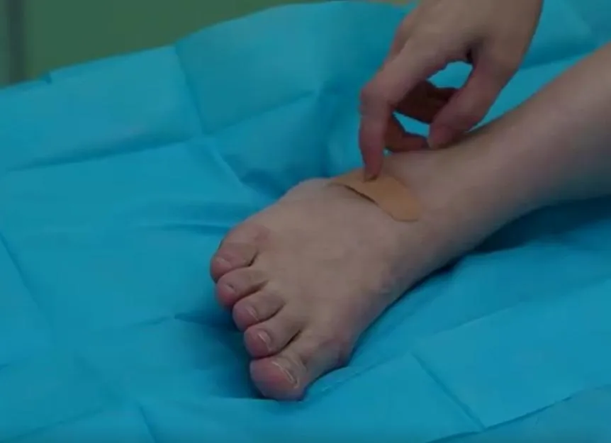 8年前,李女士發現右腳背出現一個小腫包,她表示:「就像是蚊子叮咬的那種,當時沒在意。」(圖/翻攝微博@第一現場)