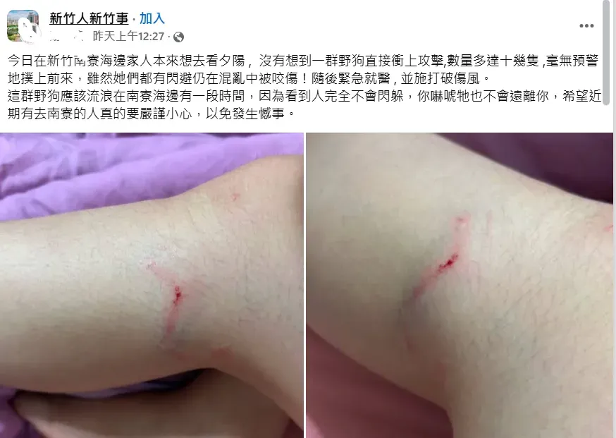 受害者PO出被流浪犬咬的傷口照。（圖／翻攝自新竹人新竹事臉書社團）