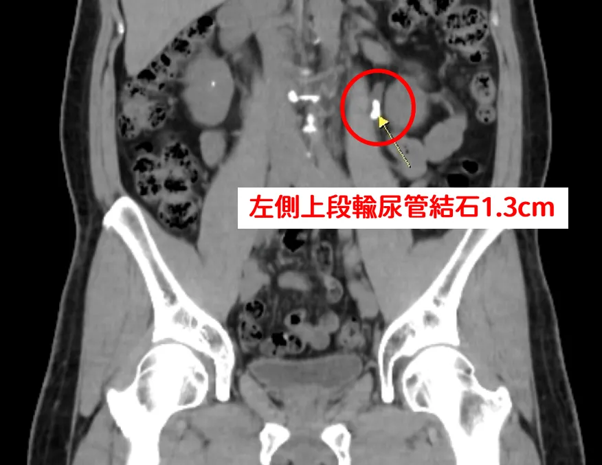 初期檢查發現患者左側腎盂輸尿管交接處有約1.3公分結石，合併左腎多顆小結石。（圖／中國醫藥大學新竹附設醫院）