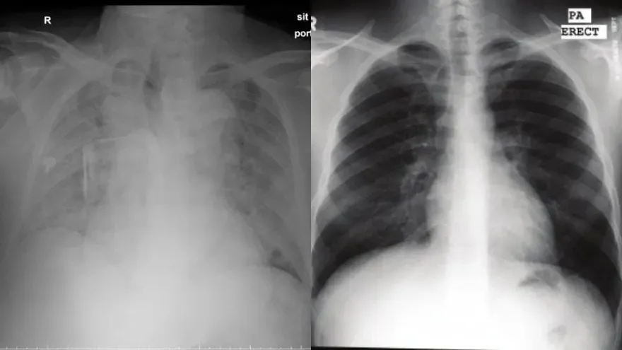 感染新冠會變「白肺」？話題衝微博熱搜！醫提醒：這症狀及時就醫