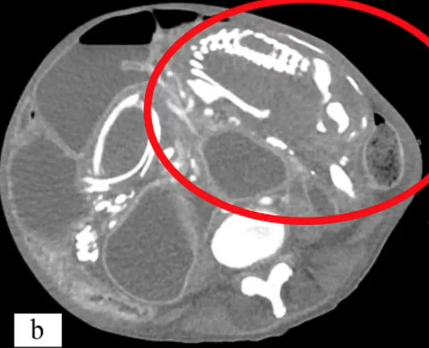 持續胃痙攣進食有咕嚕聲　50歲女子就醫發現腹中藏有「九年石頭嬰兒」