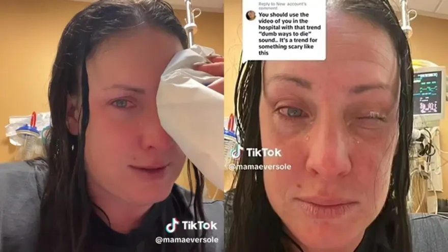 左眼突灼燒！她點眼藥水「竟拿成強力膠」　眼皮當場黏死急送醫