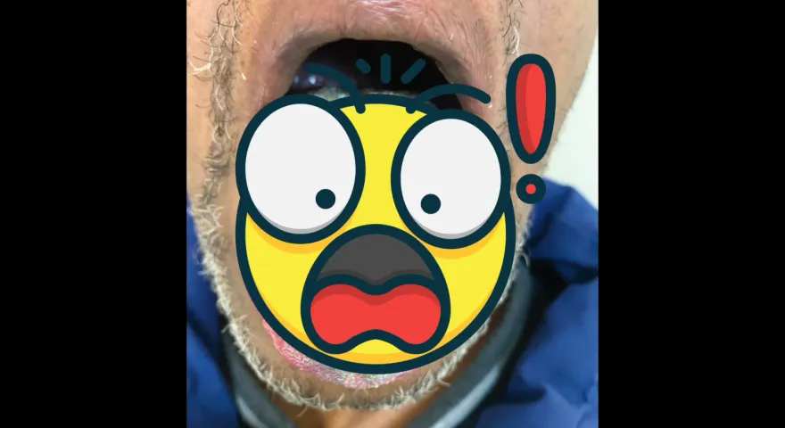 太恐怖！64歲老菸槍服用抗生素　舌頭竟「長出整片綠毛」原因曝