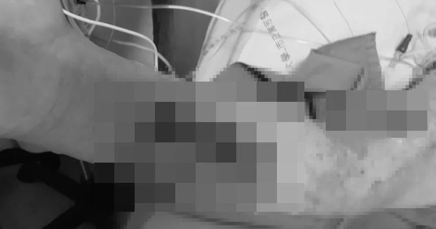 海邊釣魚遭刺傷！他3天後「手臂冒泡全爛」　醫揭恐怖關鍵警告：3類人一碰恐截肢