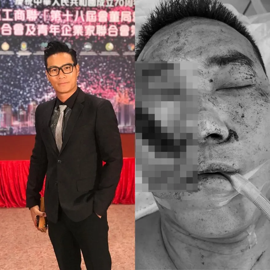 男星疑被尋錯仇「遭連砍3刀」險沒命！受傷照瘋傳「右大塊臉都沒了」恐破相