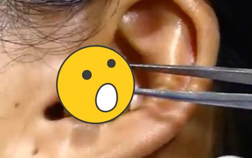 金黃巨蛇「從耳朵鑽出來」！她衝醫「碰小頭就張嘴反擊」　詭異畫面曝光…25萬人看傻