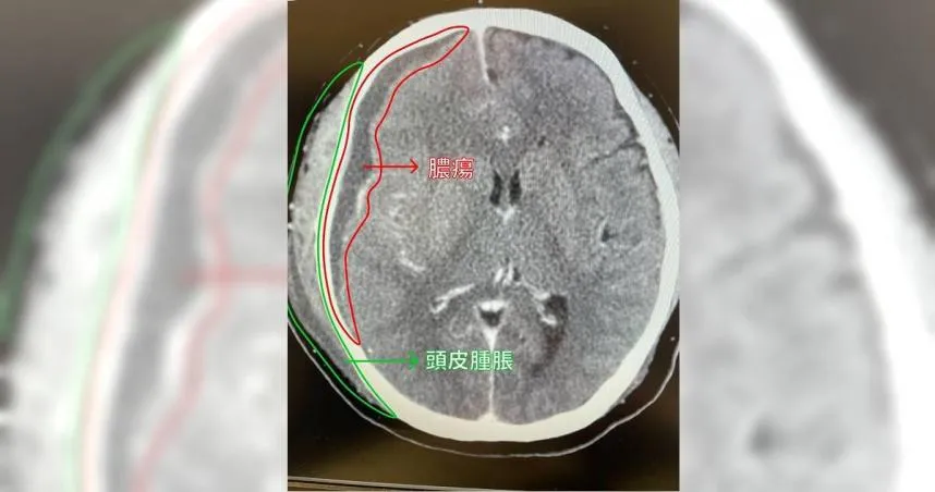 牙齦腫痛2天「呼吸困難休克」！49歲男爆深頸感染　醫警告5族群：致命風險高