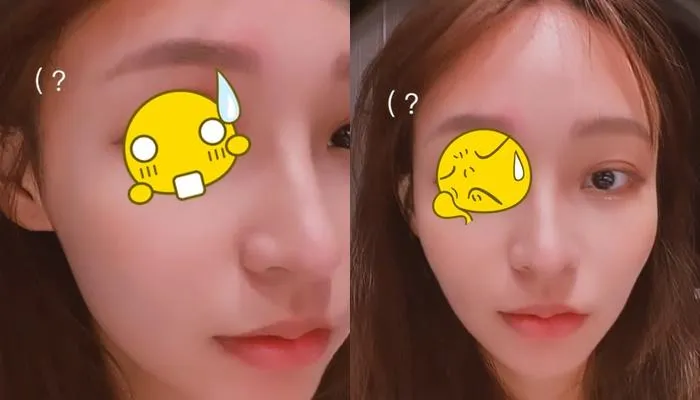 深夜PO超慘自拍照！林襄「右眼超腫」粉絲全嚇壞…親吐2字揭原因