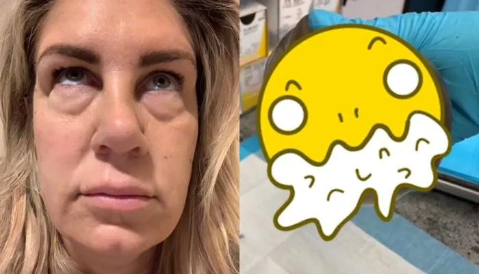 腐爛果凍塞乳10年！辣人妻全身詭腫「頭髮也掉光」　淚訴：孩子怎麼辦…