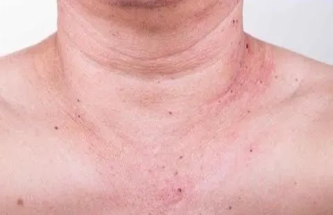 「5種痣」致死率超高！長在這部位快就醫　醫曝判斷標準一次看