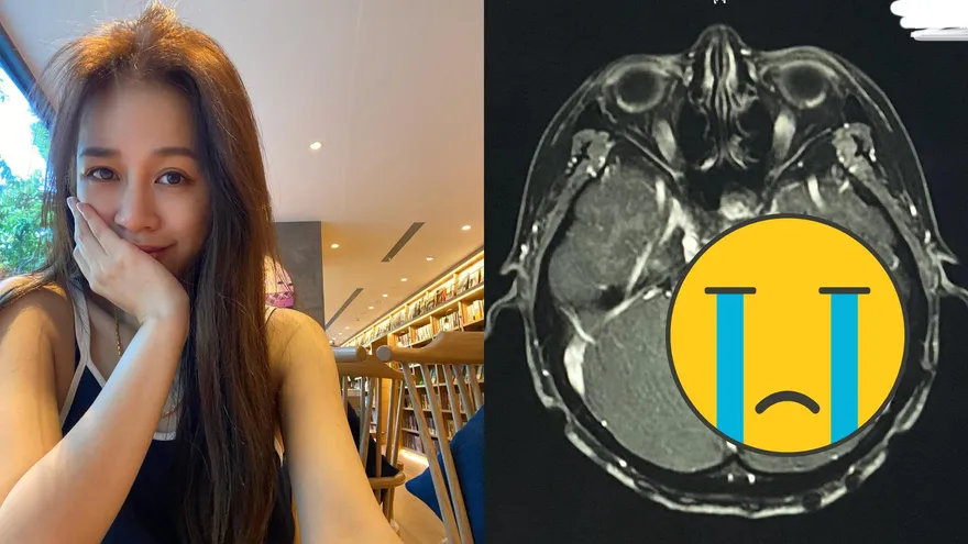 腦瘤切除3年後復發！女星治療1年「腫瘤大小不變」　「腦水腫→頭暈跌倒」現況曝