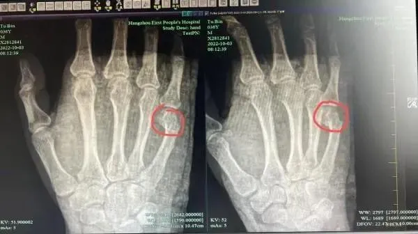 崩潰！一題講了半小時　爸爸教孩寫作業氣到捶桌致手掌骨折