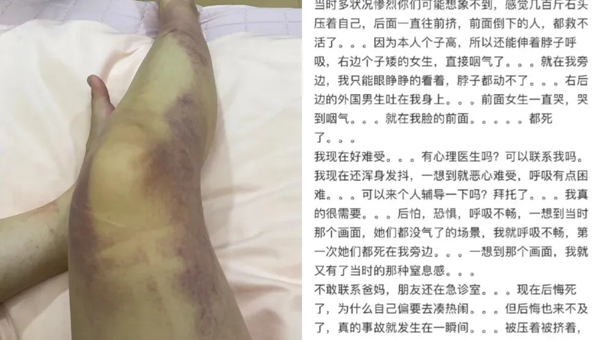梨泰院10萬人踩踏/死裡逃生「全腿瘀青傷勢曝」　倖存女：眼睜睜看旁人嚥氣…