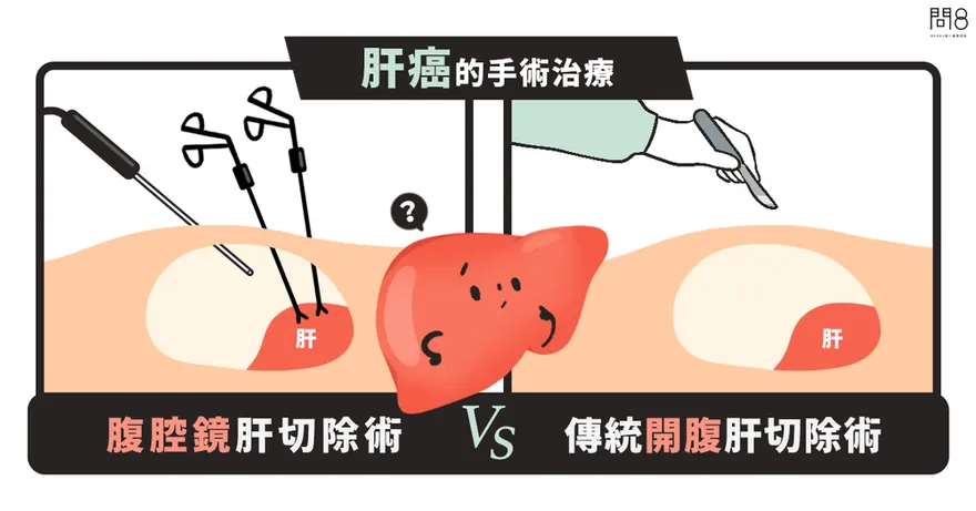 肝癌治療新選擇　醫曝新舊手術比較