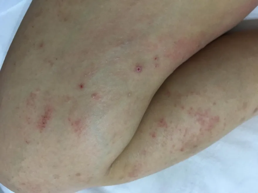 打完疫苗皮膚癢？醫：六症狀可能是嚴重藥物疹