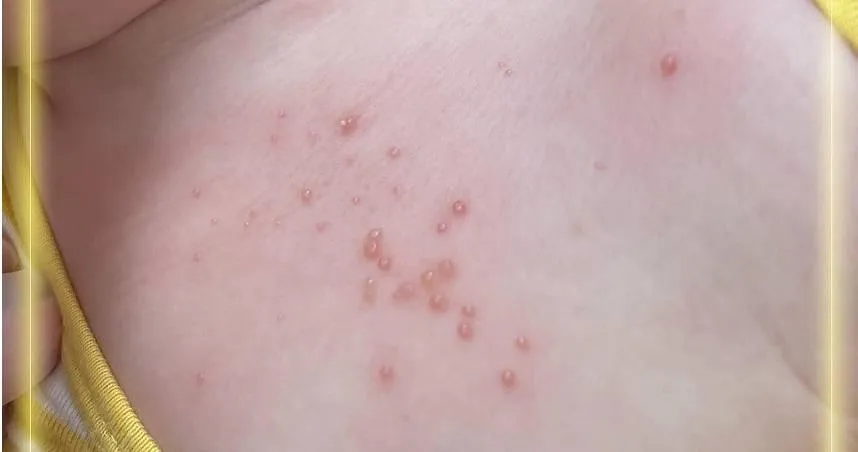 幼兒身上出現驚悚小珍珠！醫：恐是傳染性軟疣 兄弟姐妹都會被傳染