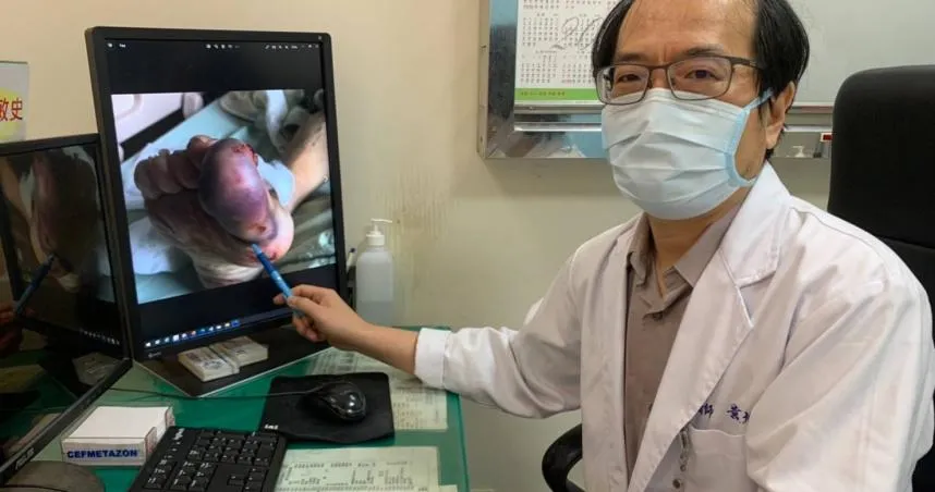 驚！老人跌倒「錯誤止血」恐截肢　醫師教3步驟正確處理傷口