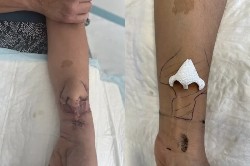 將鼻子「打印」在手臂　鼻腔癌病患因3D列印獲新生