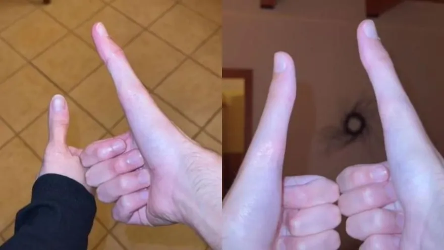 真人版魯夫！他「大拇指12.7公分」比正常人長2倍　伸縮自如影片曝