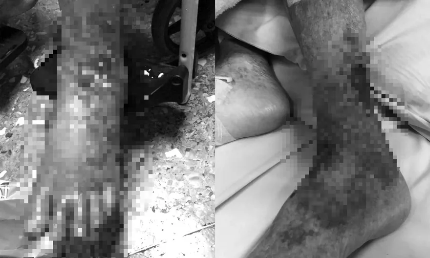 扯！照服員燙傷90歲嬤未及時處理　2日後傷口「蜂窩性組織炎」病世！